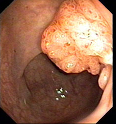 大腸ポリープが大腸癌に変化する様子