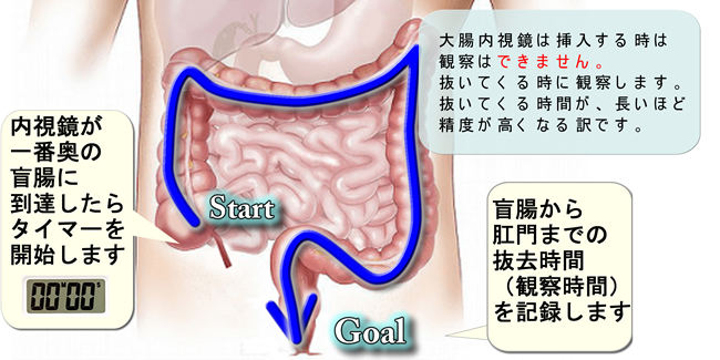 盲腸に到達したらタイマーをスタートし抜去時間（観察時間）を記録
